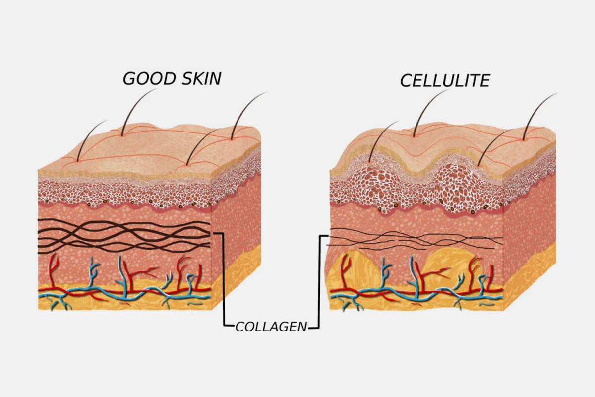 Some Important Facts About Cellulite, Collagen, and Beautiful Skin